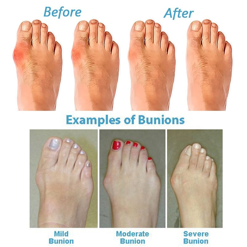 BunionRelief Sandalen: Pijnverlichting en Correctie voor Bunions en Slechte Houding